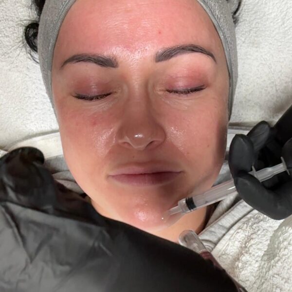 Nicole-Trautmann. Microneedling Radebeul